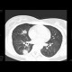 Wegener's granulomatosis: CT - Computed tomography